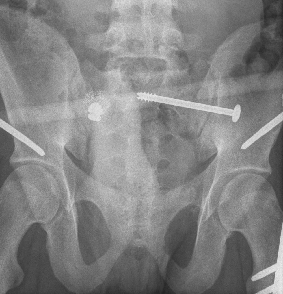 Pelvis Sacroiliac Outlet